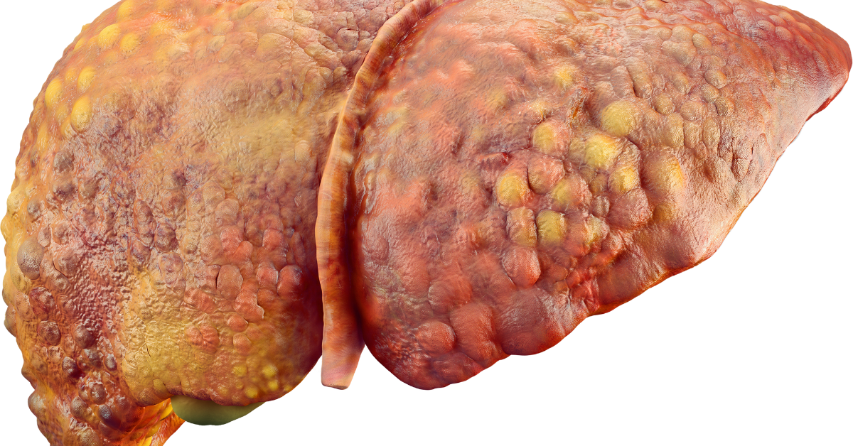 PET CT scan used for cancer staging