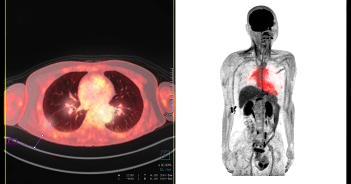 PET CT scan used for cancer recurrence detection
