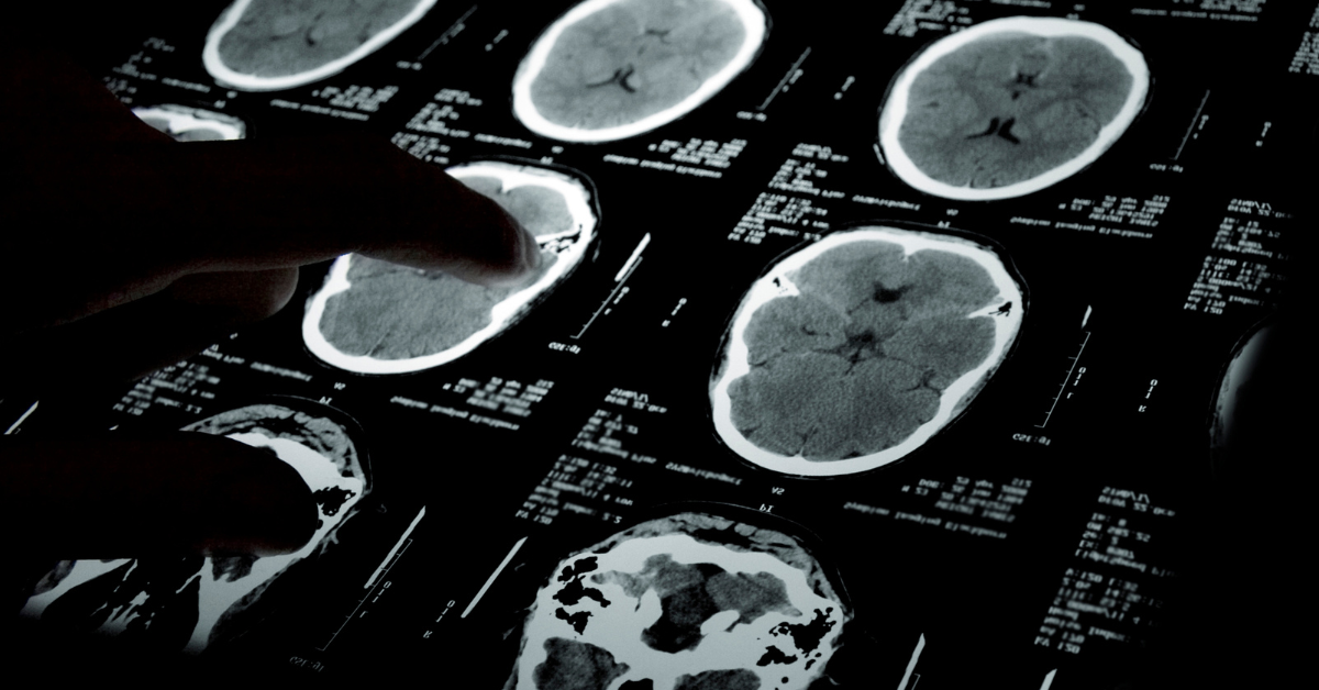 DOTA PET CT scan for neuroendocrine tumours